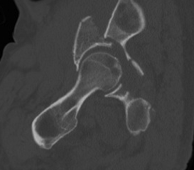 Acetabular Fracture CT Subchondral Arc 2